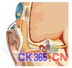图5，植入耳蜗将声音转换为电脉冲，送给听觉神经。话筒将声音捕捉给声音处理器(a)。声音处理器将声音转换为详细的数学信息 (b)。磁耳机将数字信号发送给植入的耳蜗(c)。植入耳蜗将电信号发送给听觉神经(d)。收听到的神经将脉冲发给大脑，这将脉冲解析成为声音
