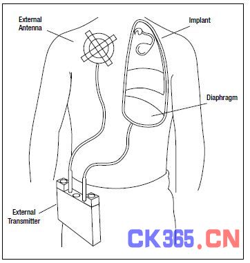 图7，呼吸起搏器带有用于膈神经刺激的植入电极以及RF接收器，还有向植入体发射RF信号的外部天线，完成刺激起搏功能